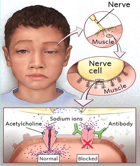 Neuromuscular Disease 